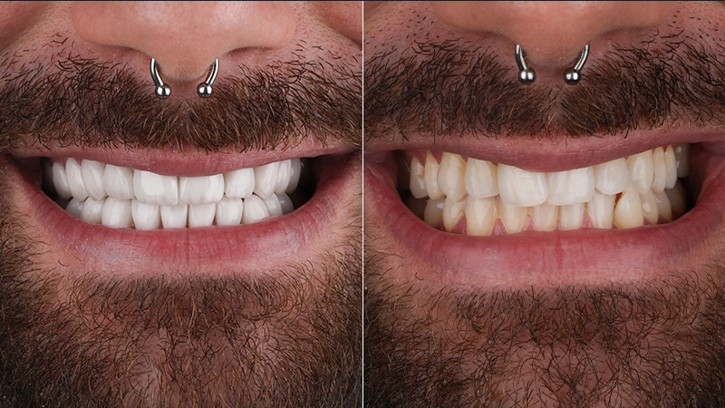 smile makeover antonio 